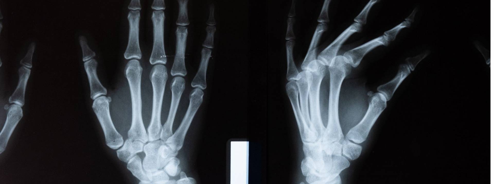 Milvue lève 8M€ afin de poursuivre sa croissance et assurer son développement international Radio des mains